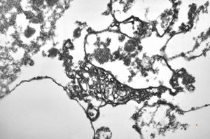 M,50y. | Pneumocystis carinii - lung M,50y. | Pneumocystis carinii - lung